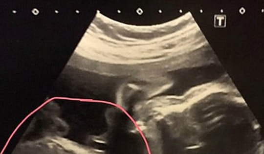 Đi khám thai, người phụ nữ 32 tuổi sốc nặng khi thấy kết quả siêu âm