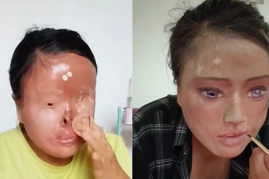 Tự vẽ lại mặt sau khi bị chồng cũ tạt axit