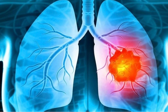 Ứng dụng AI chẩn đoán ung thư phổi sớm