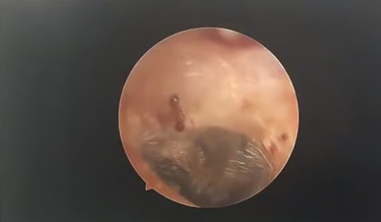 Nghe thấy âm thanh lạ trong tai, người phụ nữ đi khám thì sốc nặng