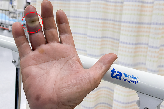 Vết thương chó cắn nhiễm trùng mới biết mắc bệnh tiểu đường