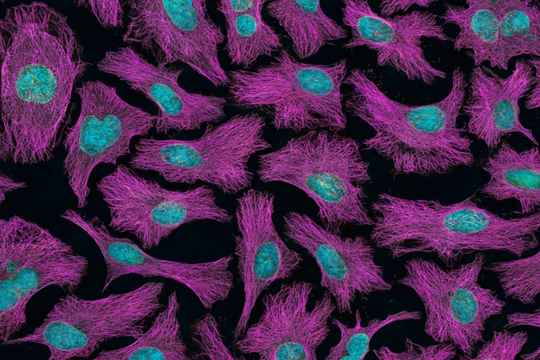 U và ung thư khác nhau như thế nào?