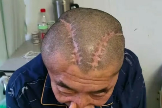 Bệnh nhân xuất huyết não phải, bác sĩ mổ nhầm não trái