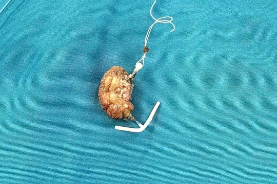 Vòng tránh thai di lệch vào bàng quang sau 22 năm