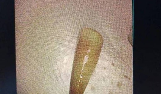 Người đàn ông liên tục ho ra máu, bác sĩ lấy ra thứ "đáng sợ" trong phổi