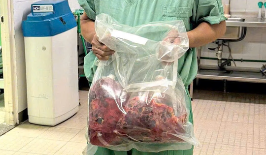 Lần đầu tiên tại Việt Nam: Cắt bỏ hai thận đa nang nặng gần 10kg, ghép thận thành công trong một ca mổ