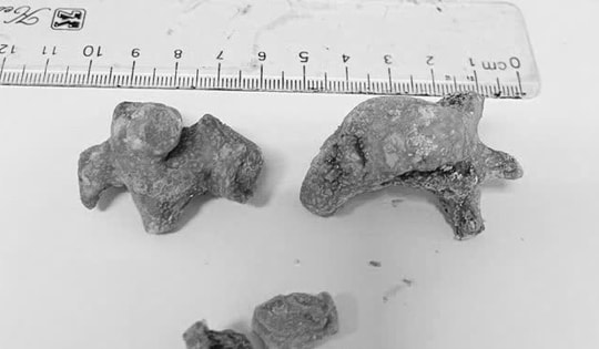 Đau quặn bụng dữ dội, người phụ nữ 55 tuổi phát hiện bí mật đáng sợ