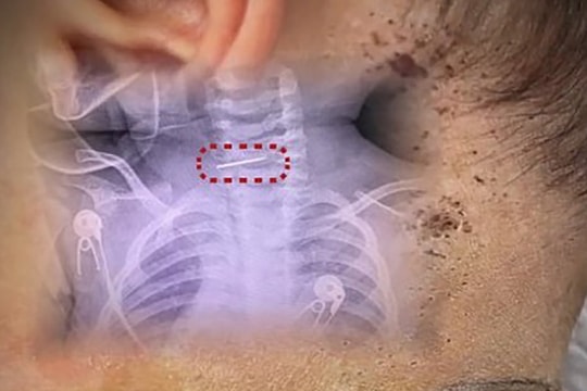 Bé 10 tháng tuổi bị mẹ đâm hàng trăm vết kim vào người để chữa bệnh