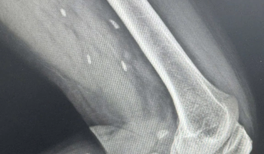 Thói quen nhiều người Việt mê mẩn khiến sán “làm tổ” dưới da mà không hay biết