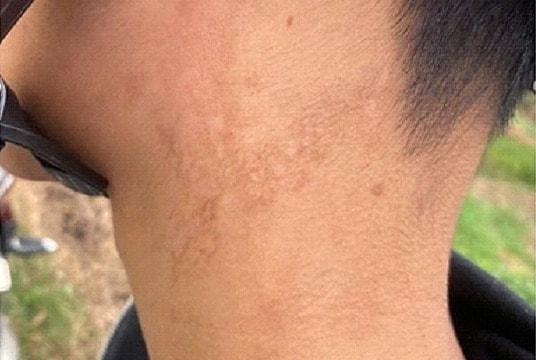 Sẩn ngứa suốt năm, đi khám phát hiện nhiễm sán dây chó