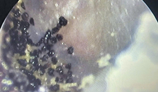 Nghe thấy âm thanh lạ trong tai, bé 7 tuổi đi khám thì sốc nặng