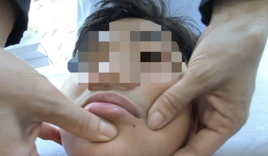 Miền Bắc rét sâu, gia tăng số người bị méo miệng: Chuyên gia chỉ cách bảo vệ sức khỏe "vàng"