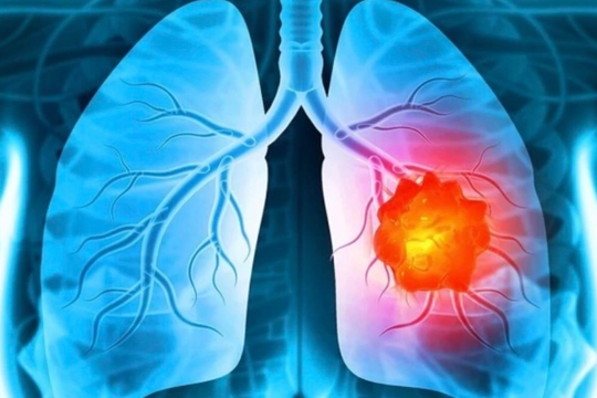 Bác sĩ chỉ ra 5 dấu hiệu cảnh báo ung thư phổi dễ bị phớt lờ