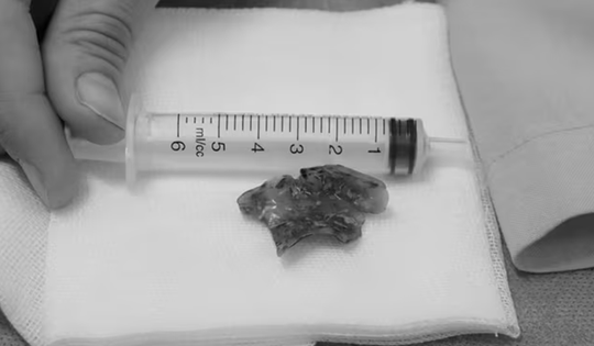 Nửa đêm đau họng, người phụ nữ 55 tuổi phát hiện bí mật "đáng sợ"