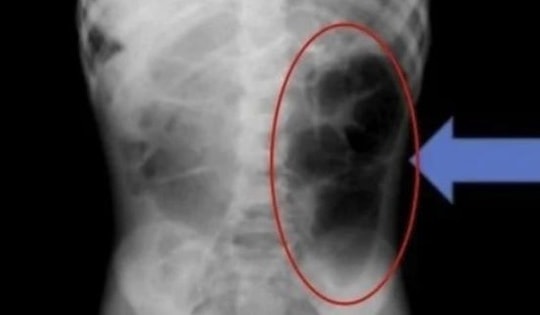 Bé gái đau bụng đi khám, bác sĩ lấy thứ "đáng sợ" bên trong