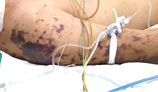 Ăn thịt lợn ở đám cỗ, người đàn ông 52 tuổi lơ mơ, nguy kịch