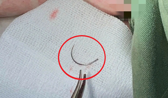 Kim khâu “mắc kẹt” suốt 11 năm trong cơ thể, người phụ nữ đến viện cầu cứu