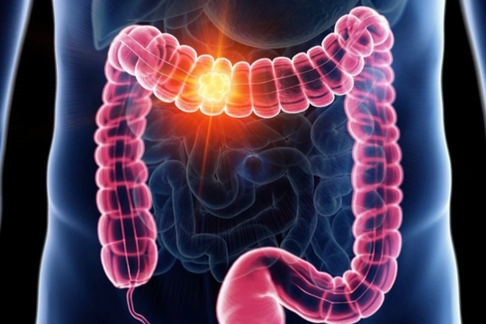 8 dấu hiệu cảnh báo sớm ung thư đại trực tràng dễ bị ngó lơ