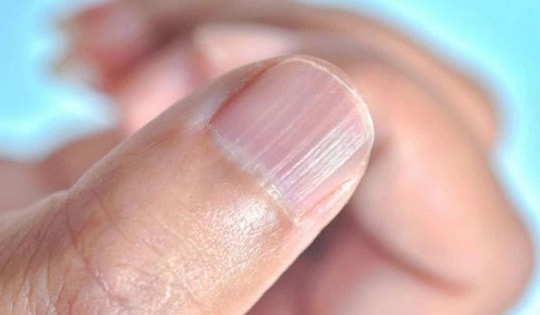 Móng tay nổi sọc dọc, cảnh báo dấu hiệu bất thường vấn đề sức khỏe