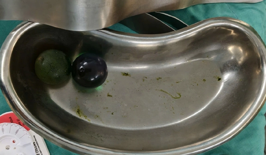 Bé gái 18 tháng tuổi nguy kịch, bác sĩ gắp ra thứ "đáng sợ" trong bụng