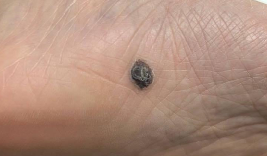 5 dấu hiệu nốt ruồi có thể là ung thư da, dấu hiệu số 1 dễ bị bỏ qua