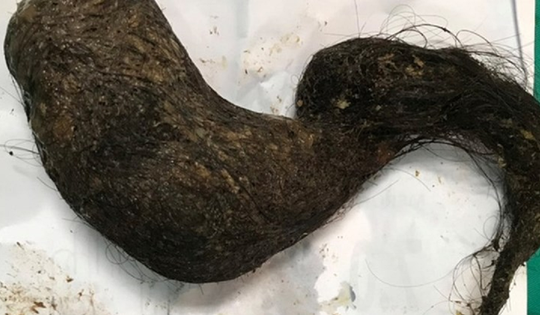 Bé trai bụng cứng như đá, bác sĩ choáng khi phát hiện "bí mật" bên trong