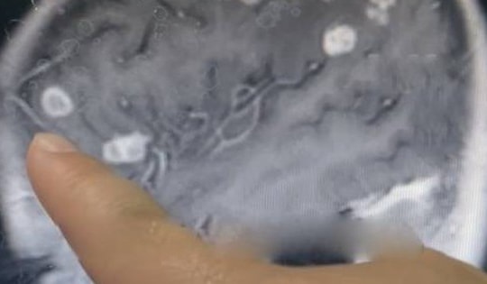 Bé gái sốt liên tục 17 ngày, bác sĩ sốc nặng khi phát hiện "bí mật" đáng sợ