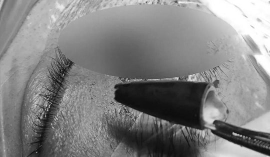 Người đàn ông đau mắt dữ dội, bác sĩ lấy ra thứ "đáng sợ"