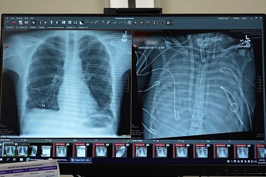 Người đàn ông sống sót 48 giờ với lồng ngực không phổi