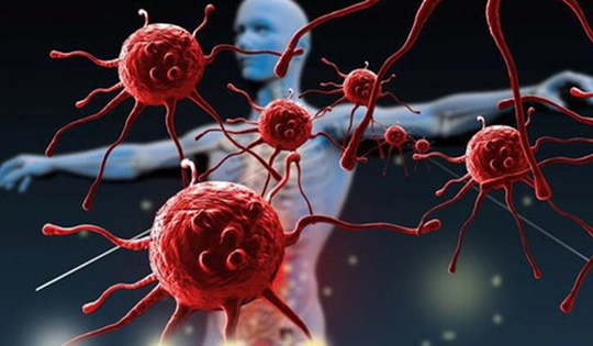 Ăn cơm có cảm giác nuốt vướng, người đàn ông sốc khi phát hiện 3 bệnh ung thư cùng lúc