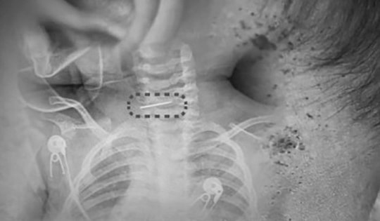 Bé trai bị sốt và co giật, bác sĩ phát hiện ra điều đáng sợ