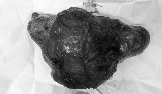 Cụ bà 72 tuổi đau âm ỉ nhiều ngày, bác sĩ sốc khi lấy ra thứ "đáng sợ" bên trong bụng