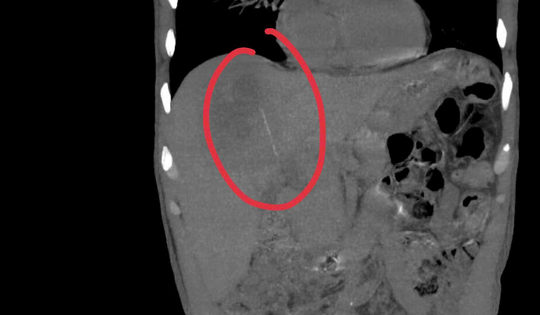 Người đàn ông đau bụng kéo dài, bác sĩ sốc khi phát hiện bí mật bên trong