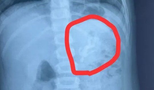 Bé trai liên tục nôn mửa, bác sĩ sốc nặng khi thấy thứ bên trong bụng