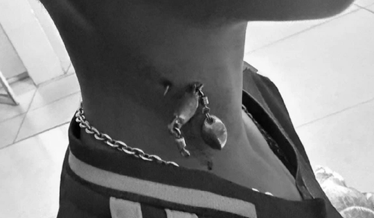 Bé trai 13 tuổi chảy máu nhiều, bác sĩ sốc khi phát hiện bí mật "đáng sợ" ở cổ