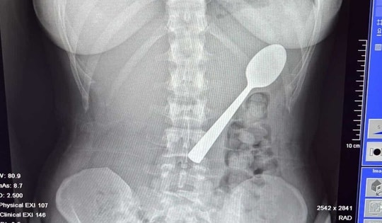 Đang ăn sữa chua, người phụ nữ nuốt chiếc thìa dài 17cm vào bụng