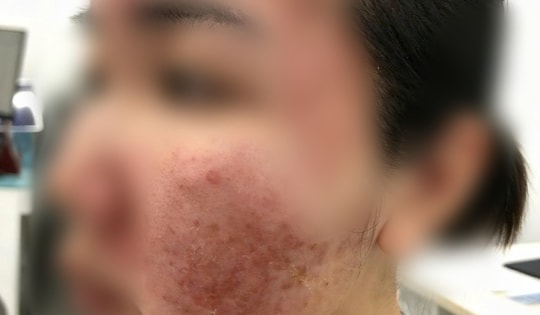 Cơn ác mộng của thiếu nữ chỉ sau vài giờ được mời làm đẹp cấp tốc đón Tết