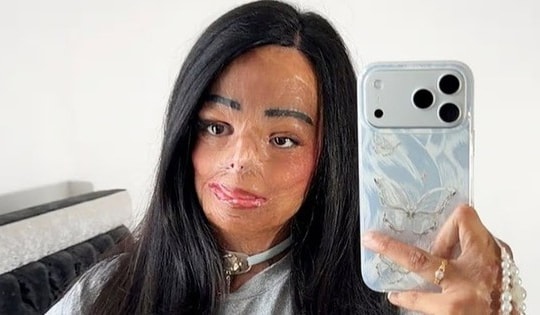 Dầu gội đầu bắt lửa, cô gái xinh đẹp bị bỏng nửa người và cái kết bất ngờ