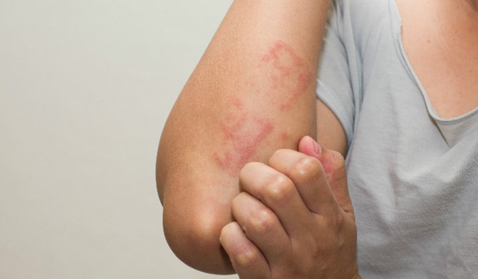 Ngứa không dứt, người phụ nữ 37 tuổi phát hiện cơ thể nhiễm tới 5 loại ký sinh trùng