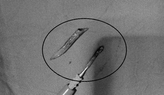 Người đàn ông 41 tuổi đau bụng, bác sĩ sốc phát hiện ra thứ đáng sợ "đi lạc" trong bụng