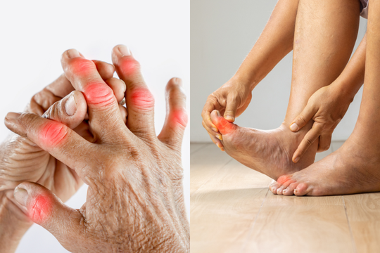 Nguyên tắc ăn uống và vận động giúp người bệnh gút đón Tết an toàn