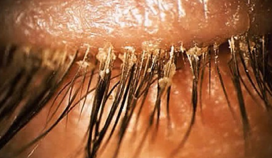 Người phụ nữ 24 tuổi khó chịu ở mí mắt, bác sĩ sốc khi gắp ra thứ "đáng sợ" chi chít trên mi