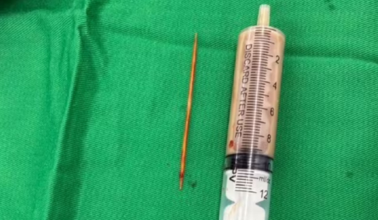 Người đàn ông bụng "cứng như đá" 2 tuần, bác sĩ phát hiện nguyên nhân bất ngờ