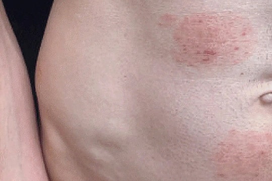 Nấm da lây truyền qua đường tình dục bùng phát tại Mỹ