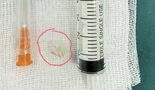 Bé trai 7 tuổi xẹp phổi trái, bác sĩ gắp ra thứ "đáng sợ" bên trong