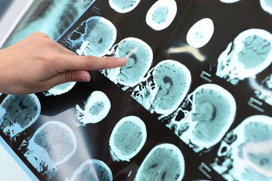 Tưởng mệt mỏi thông thường, hóa đột quỵ