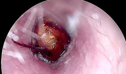 Cháu bé đau tai dữ dội, bác sĩ sốc ngang phát hiện bí mật "đáng sợ" bên trong