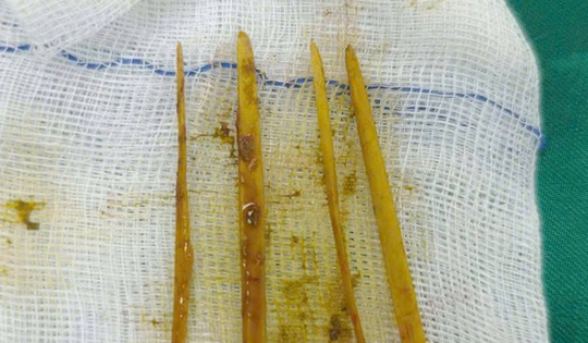 Cô gái 26 tuổi đau bụng dữ dội, bác sĩ “chết lặng” khi phát hiện thứ bên trong