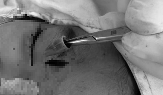 Bé trai đau vùng mắt dữ dội, bác sĩ sốc khi phát hiện dị vật "tàng hình"