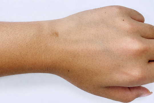 5 loại ung thư di truyền thường gặp